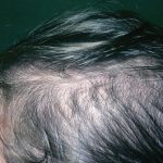 female_hair_loss