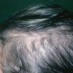 female_hair_loss