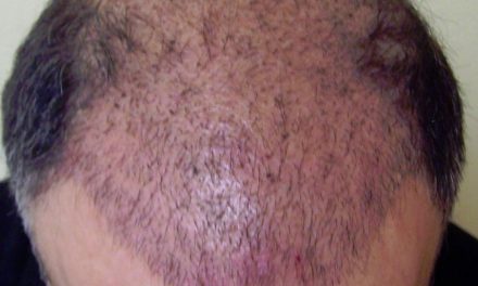 How To Restore Your Hair
