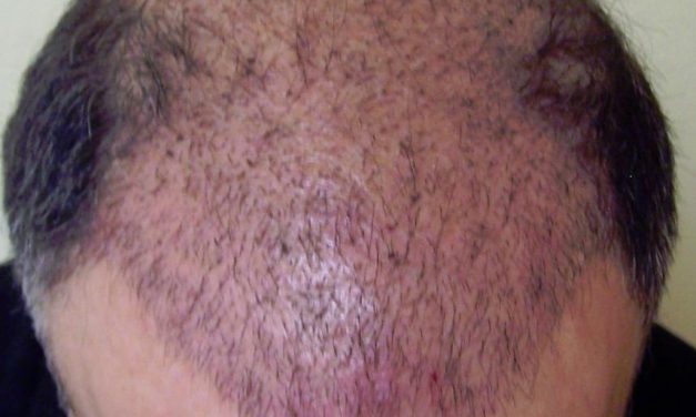 How To Restore Your Hair