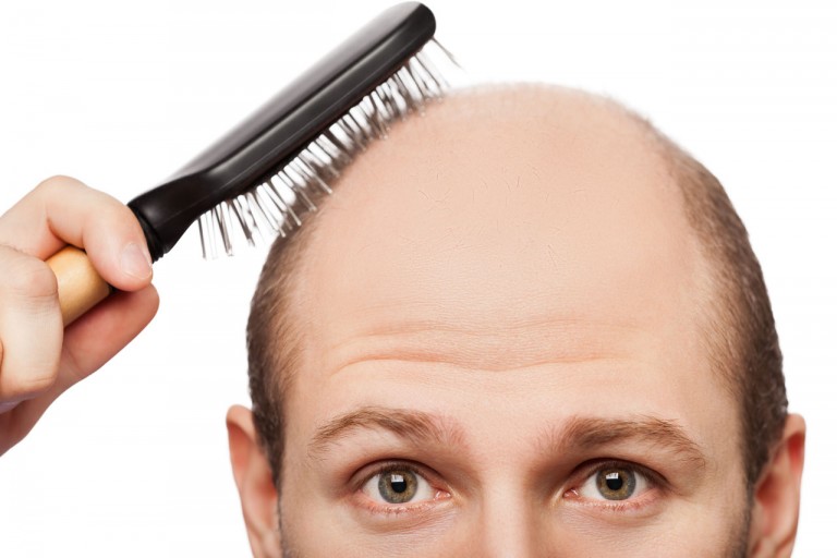 3 Ways To Treat Hair Loss