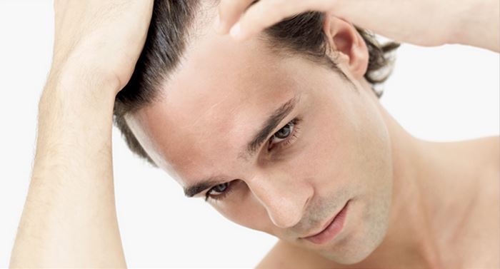 Male hair loss