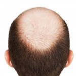 male-pattern-baldness