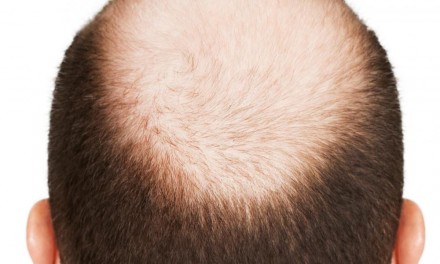7 Stages of Male Pattern Baldness