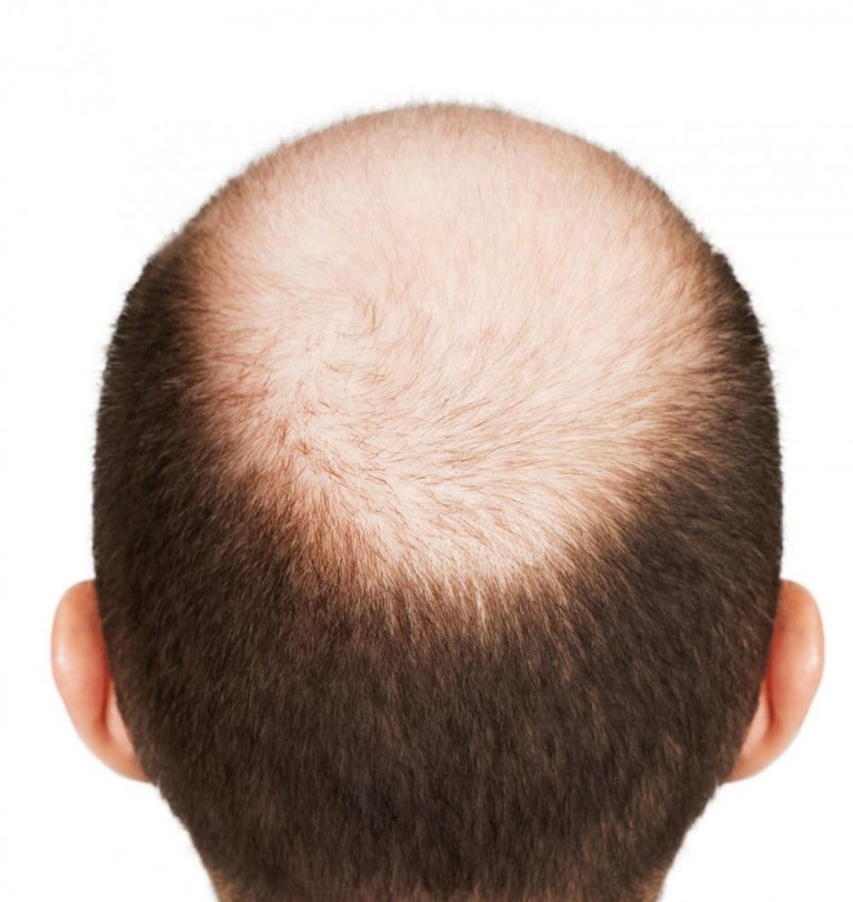 7 Stages of Male Pattern Baldness