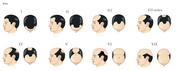 Norwood Chart Pattern Baldness