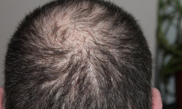 Topical Anthralin for Hair Loss: 4 Pros and Cons