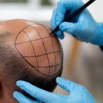 mature-man-going-through-follicular-unit-extraction-process (1)