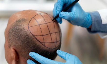 An Introduction to Hair Transplants