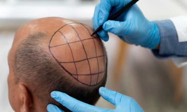 An Introduction to Hair Transplants