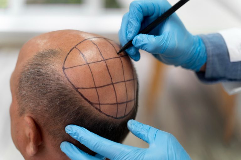 An Introduction to Hair Transplants