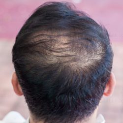 Causes of Hair Loss - Uncovering the Top 5 Common Reasons bald talk Causes of Hair Loss 1