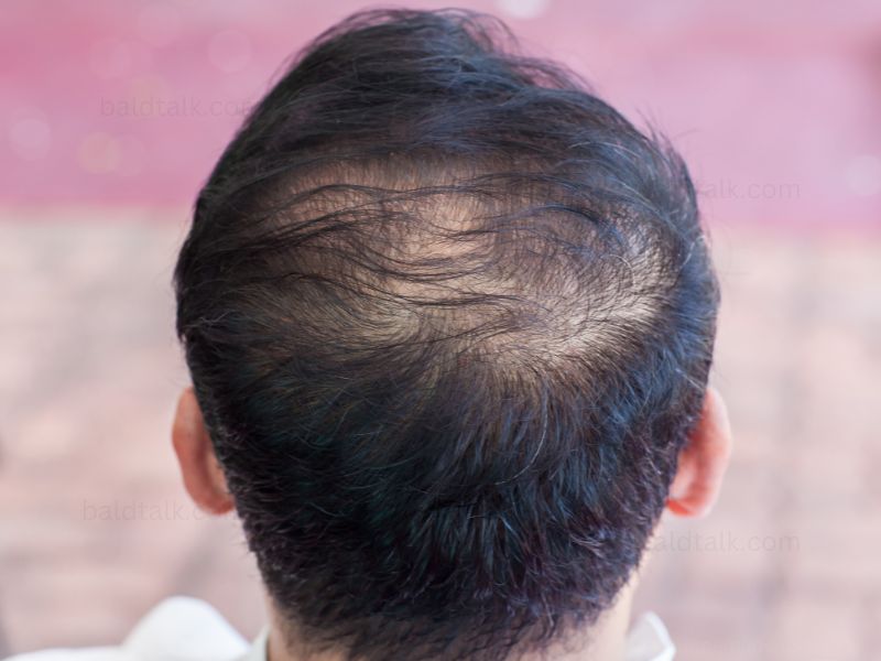 Causes of Hair Loss – Uncovering the Top 5 Common Reasons