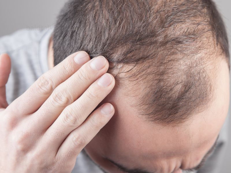 Understanding Hair loss 